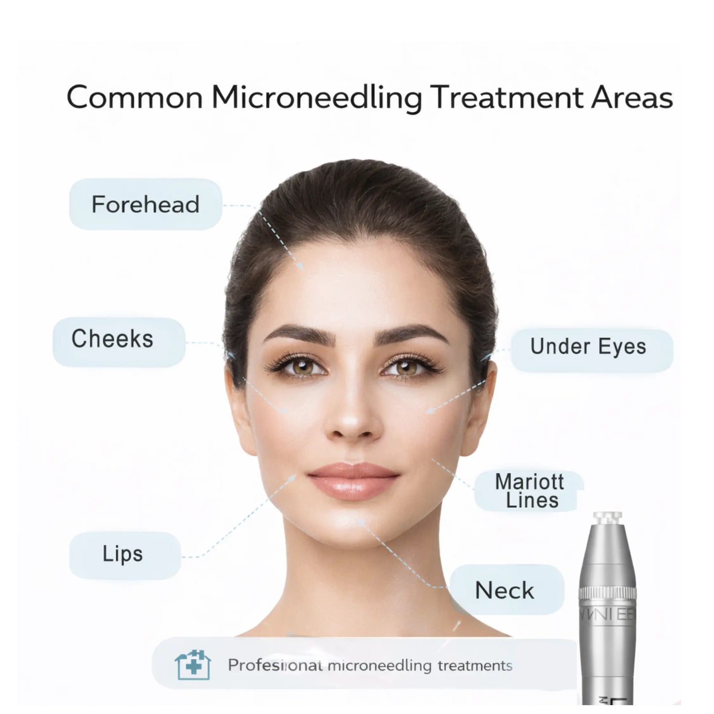 Diagram showing common microneedling treatment areas on a woman's face with a microneedling tool.