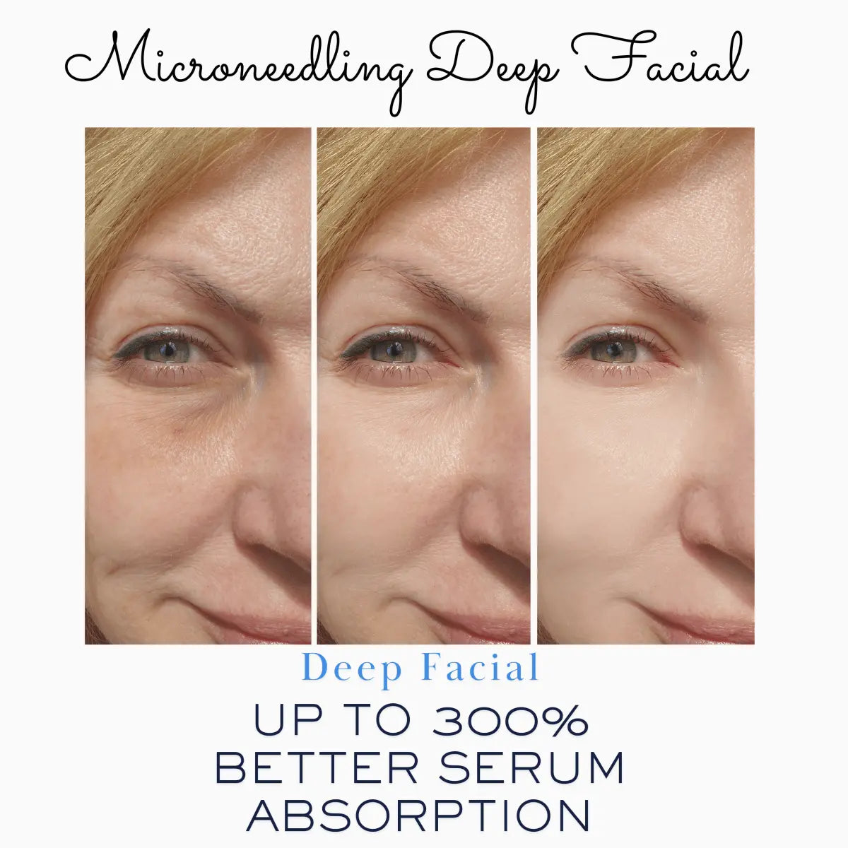 Microneedling Cartridge | Facial - LushnLavish.com