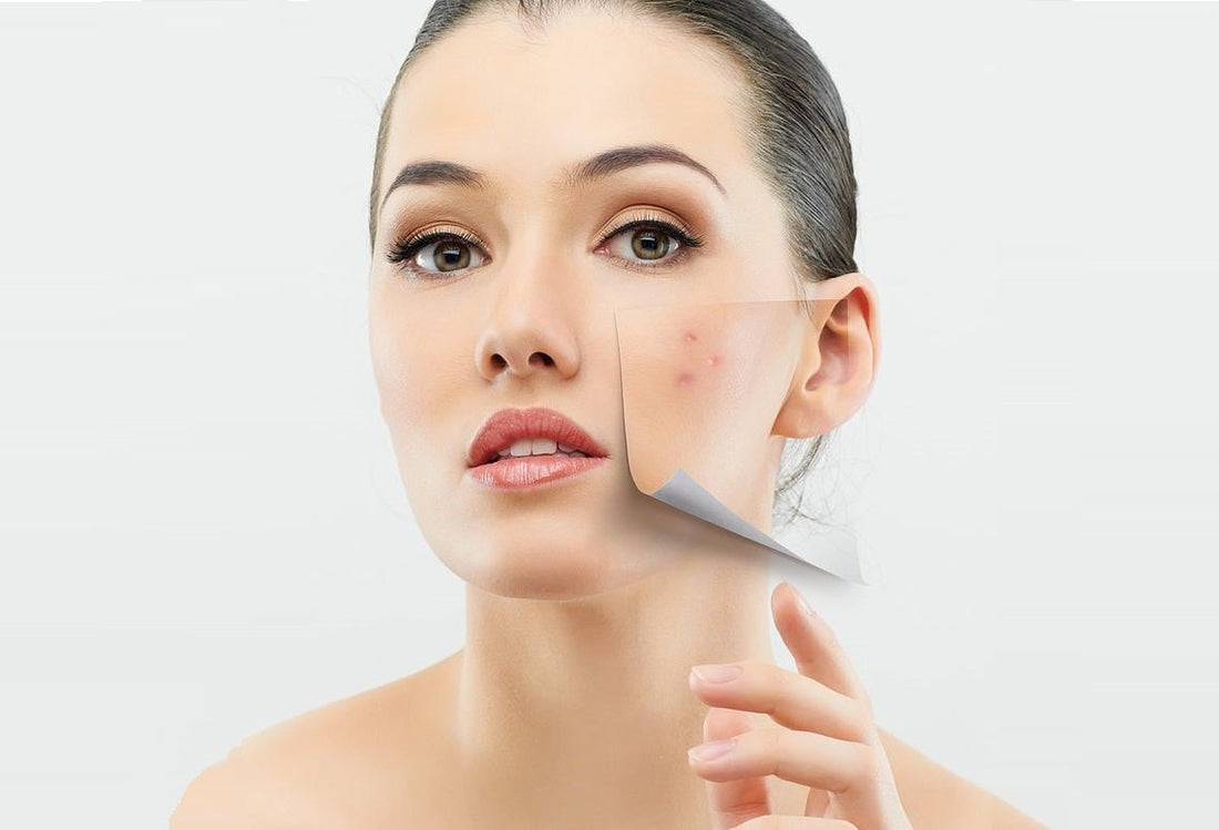 Best Microneedling Devices for Acne Scars: What to Look For - LushnLavish.com