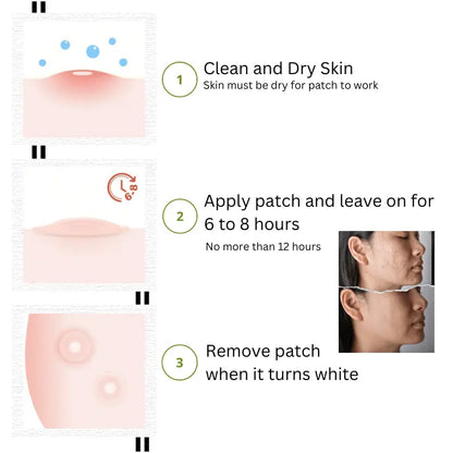 Acne Patch Treatment - LushnLavish.com