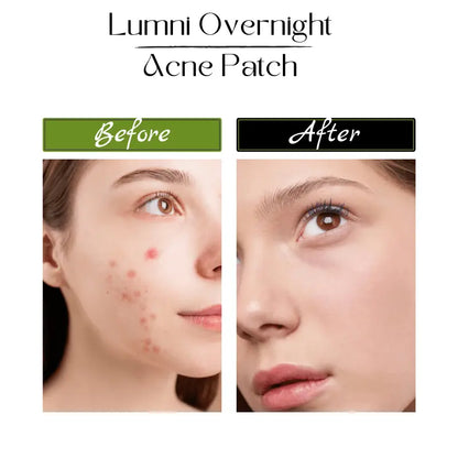 Acne Patch Treatment - LushnLavish.com