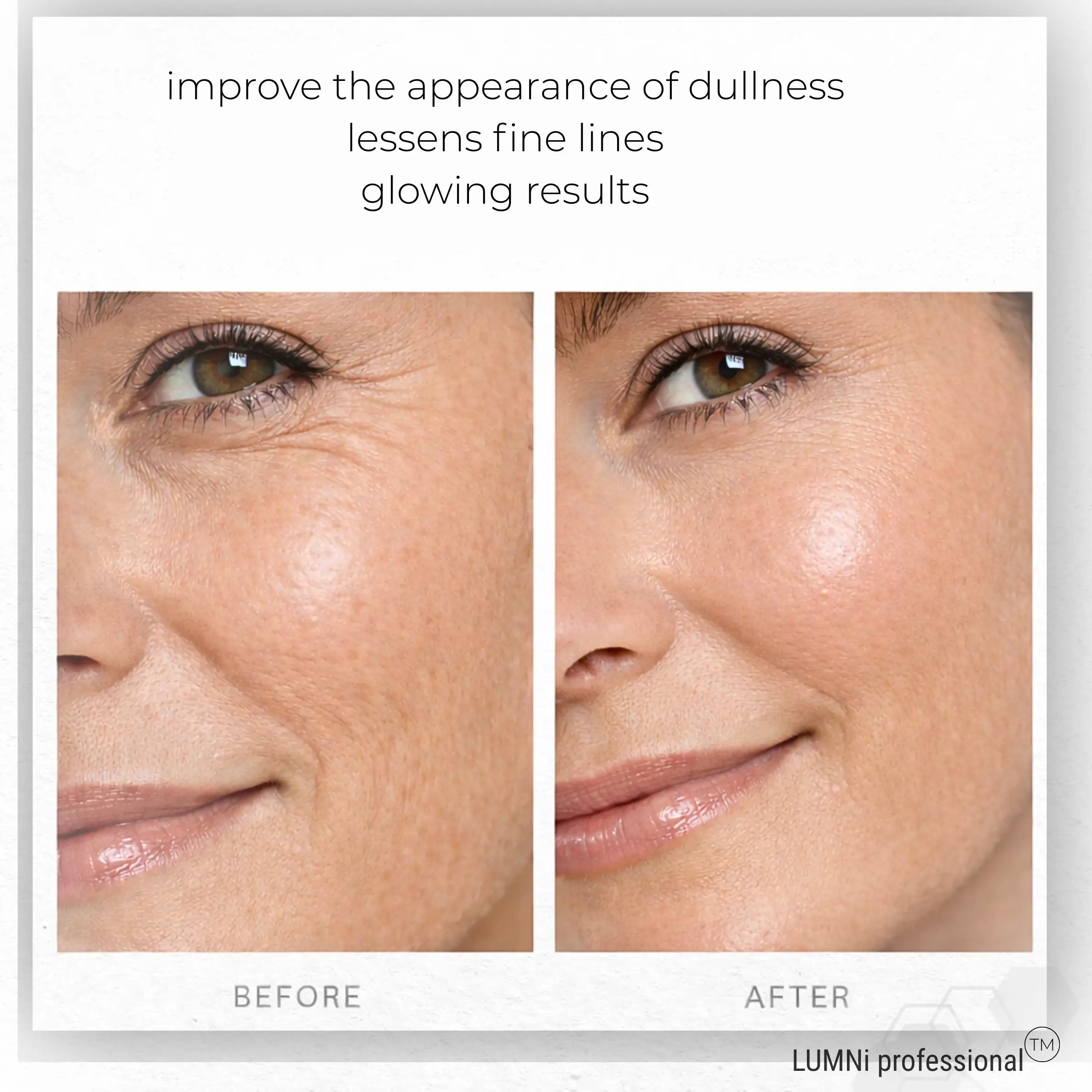 before and after using microneedling serum with hyaluroinc acid showing glowing skin and fewer fine lines