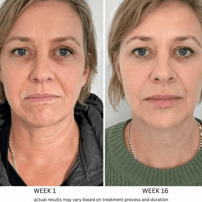Microneedling Kit with Collagen